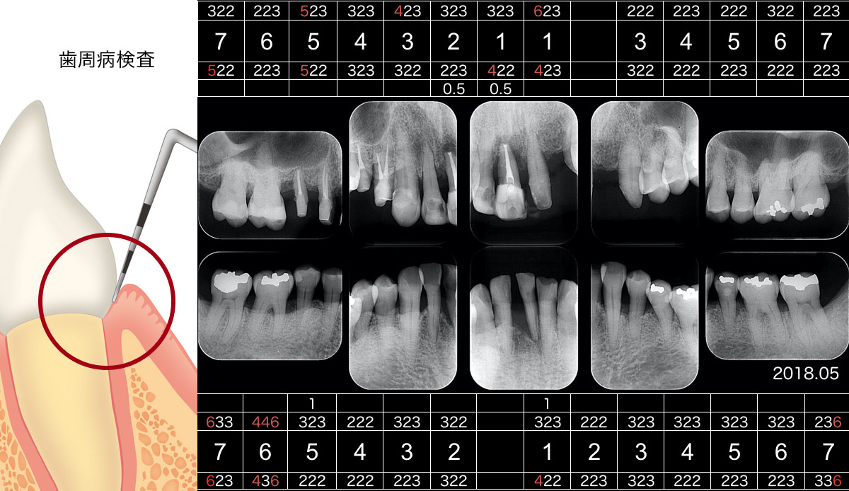 歯周病検査